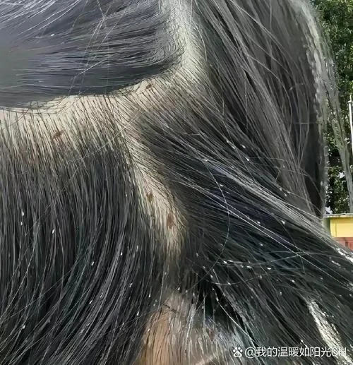 梦见头发生虱子_1