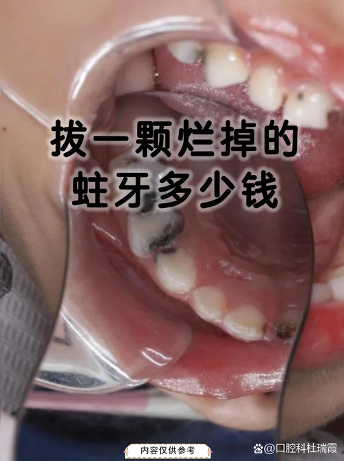 梦见蛀牙牙掉了-梦见牙掉