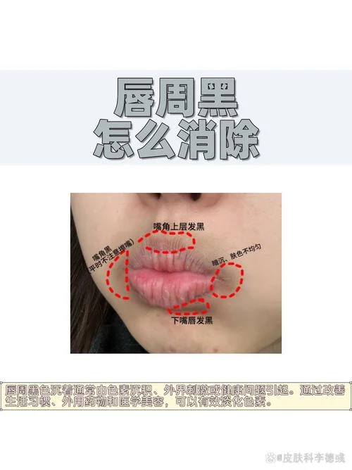 为什么唇珠是凹进去的_1