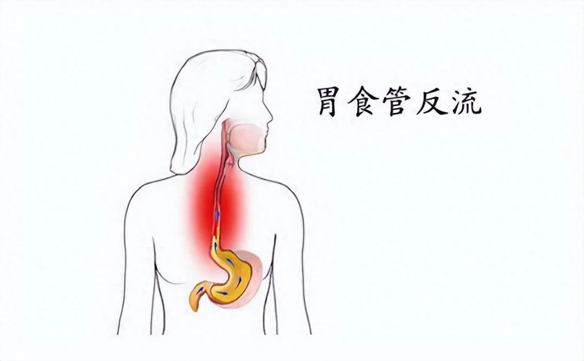 什么是食道反流_1