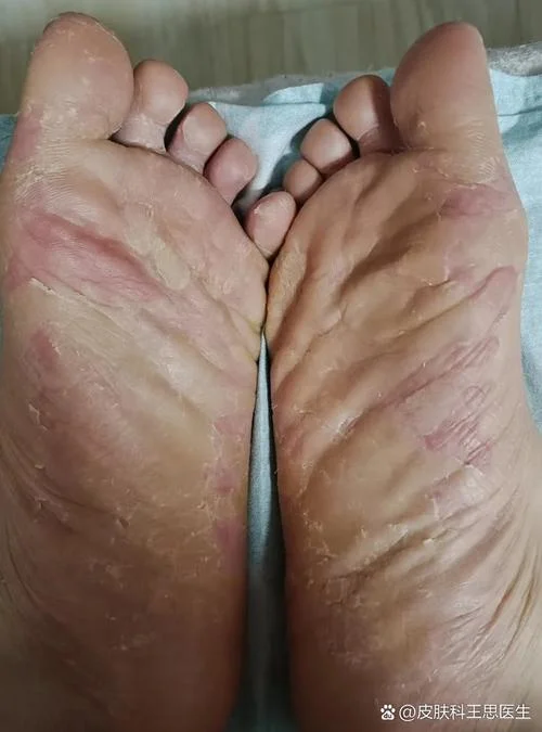 长沙治足癣多少钱_2