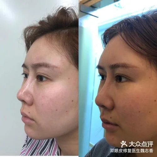 假体隆眉弓多少钱_1