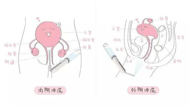 怀孕期间阴道有异味怎么办_2