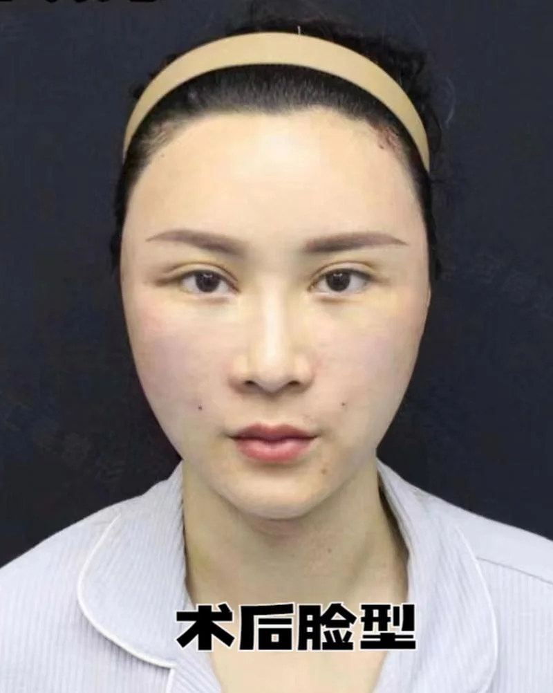 削颧骨手术要多少钱_2