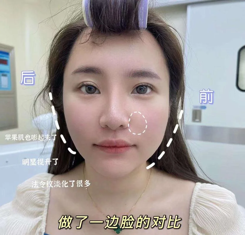 fotona欧洲之星原理-