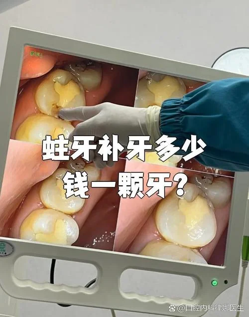 上海补牙多少钱一颗_1