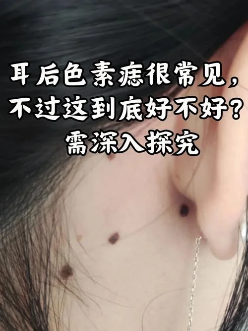 痣后天长出来是为什么_1