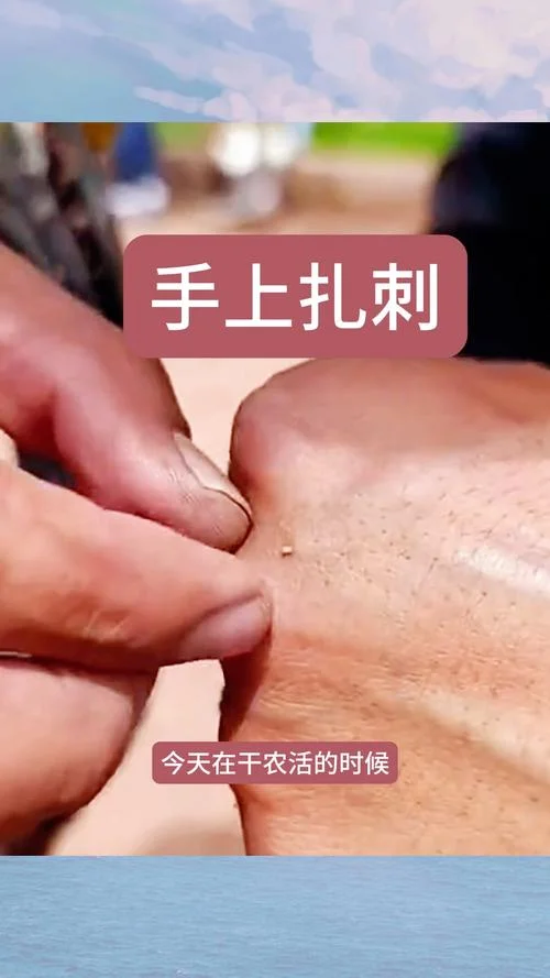 梦见手上扎了刺拔掉了_2