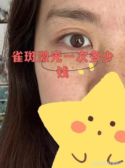 做激光祛斑多少钱一次_2
