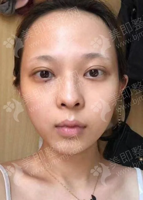 中山整容一般多少钱_2