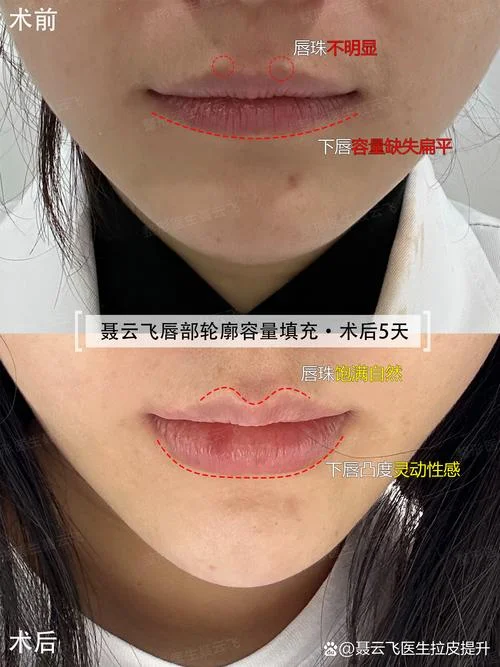 为什么唇珠是凹进去的-唇珠为何凹陷