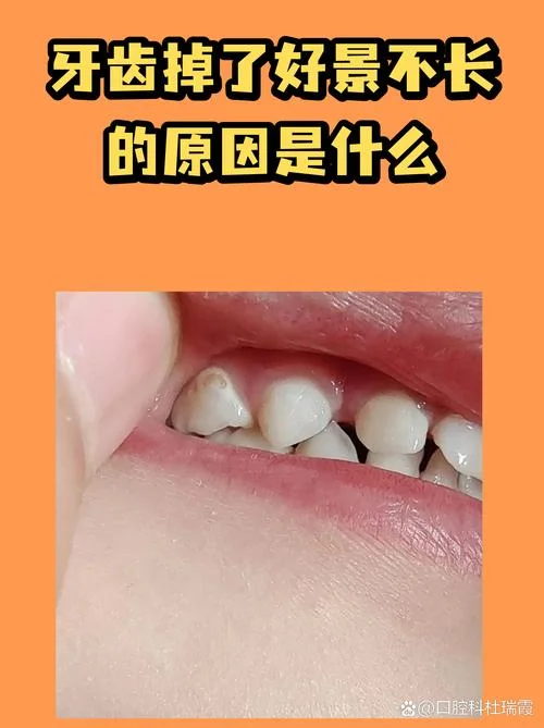 梦到自己牙齿掉了好多颗是什么意思_1
