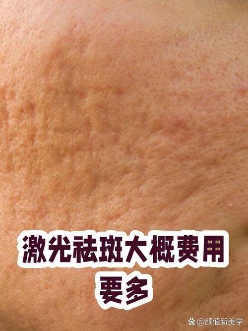 脸上点斑多少钱_2