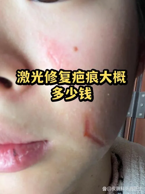 激光祛疤多少钱一次_1
