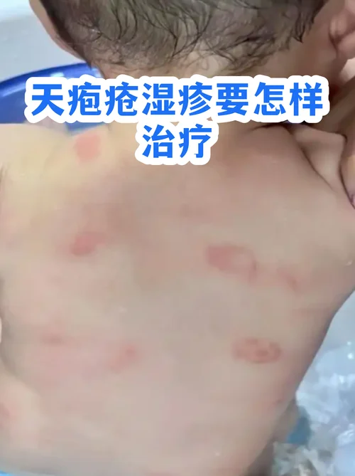 什么人容易天疱疮-易发天疱疮人群