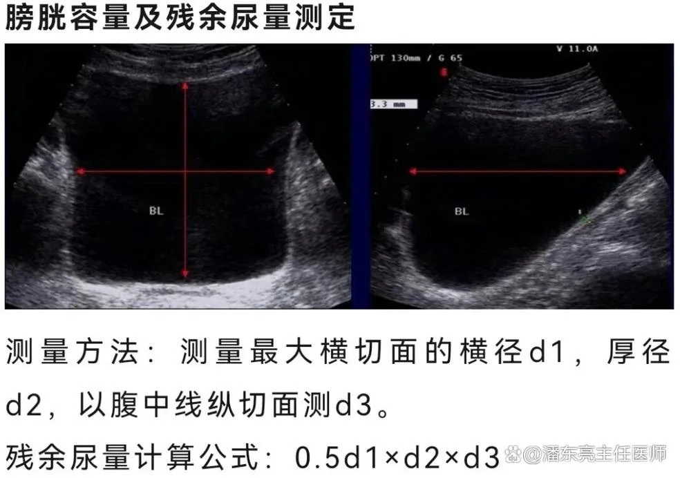 膀胱残余尿计算公式_1
