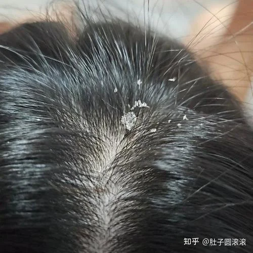 梦到头皮屑_1