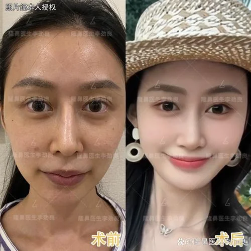 假鼻子修复大概多少钱_2