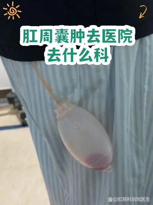 什么是肛肠囊肿-肛肠囊肿含义