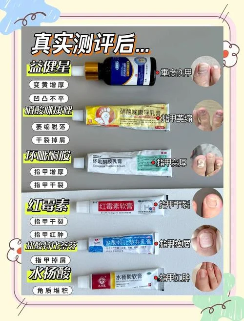 灰指甲去药店买什么药_1