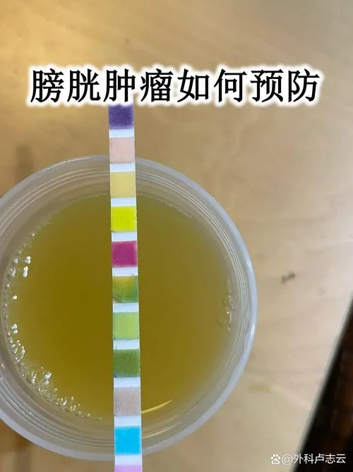 膀胱癌如何筛查-膀胱癌筛查指南