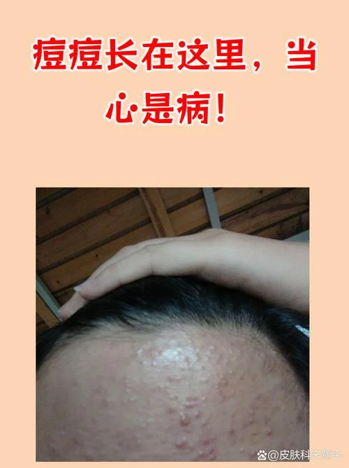 额头长痘痘是什么意思-额头长痘是什么意思