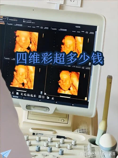 孕期做四维多少钱_1