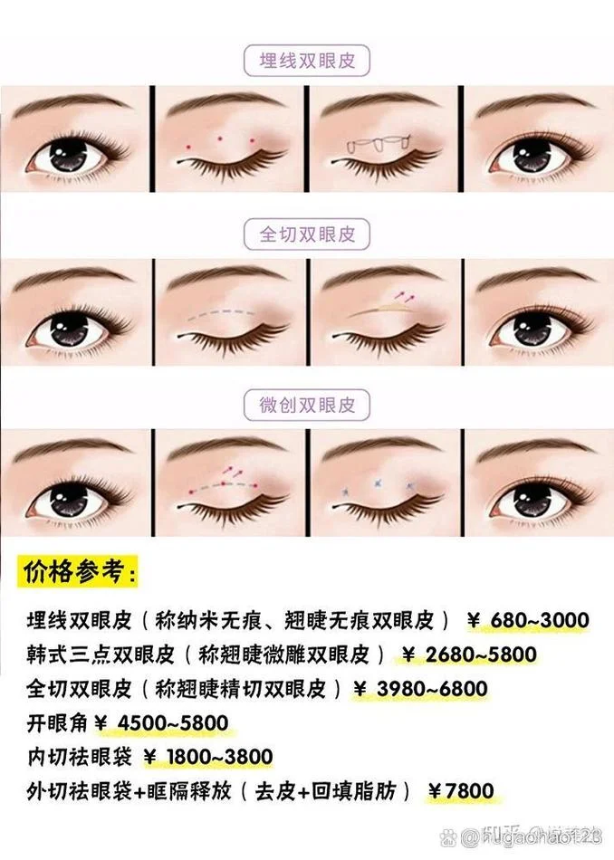 拉双眼皮要花多少钱_2