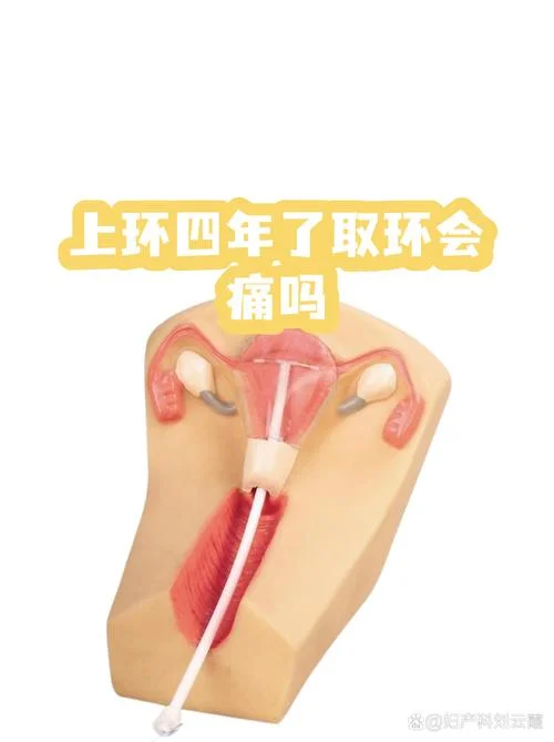 上环200元是放什么环_2