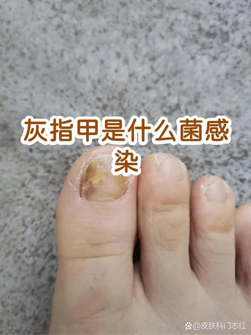 小孩灰指甲是缺什么_1