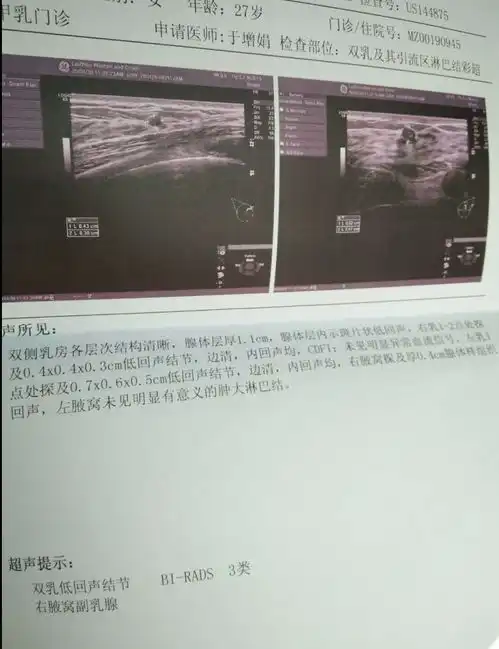幸运的我3个月祛除乳腺结节,找对方法很重要