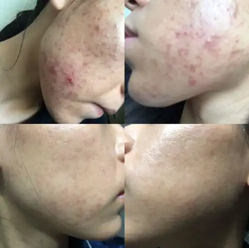 祛痘,祛痘印和收缩毛孔的有没有好方法推荐